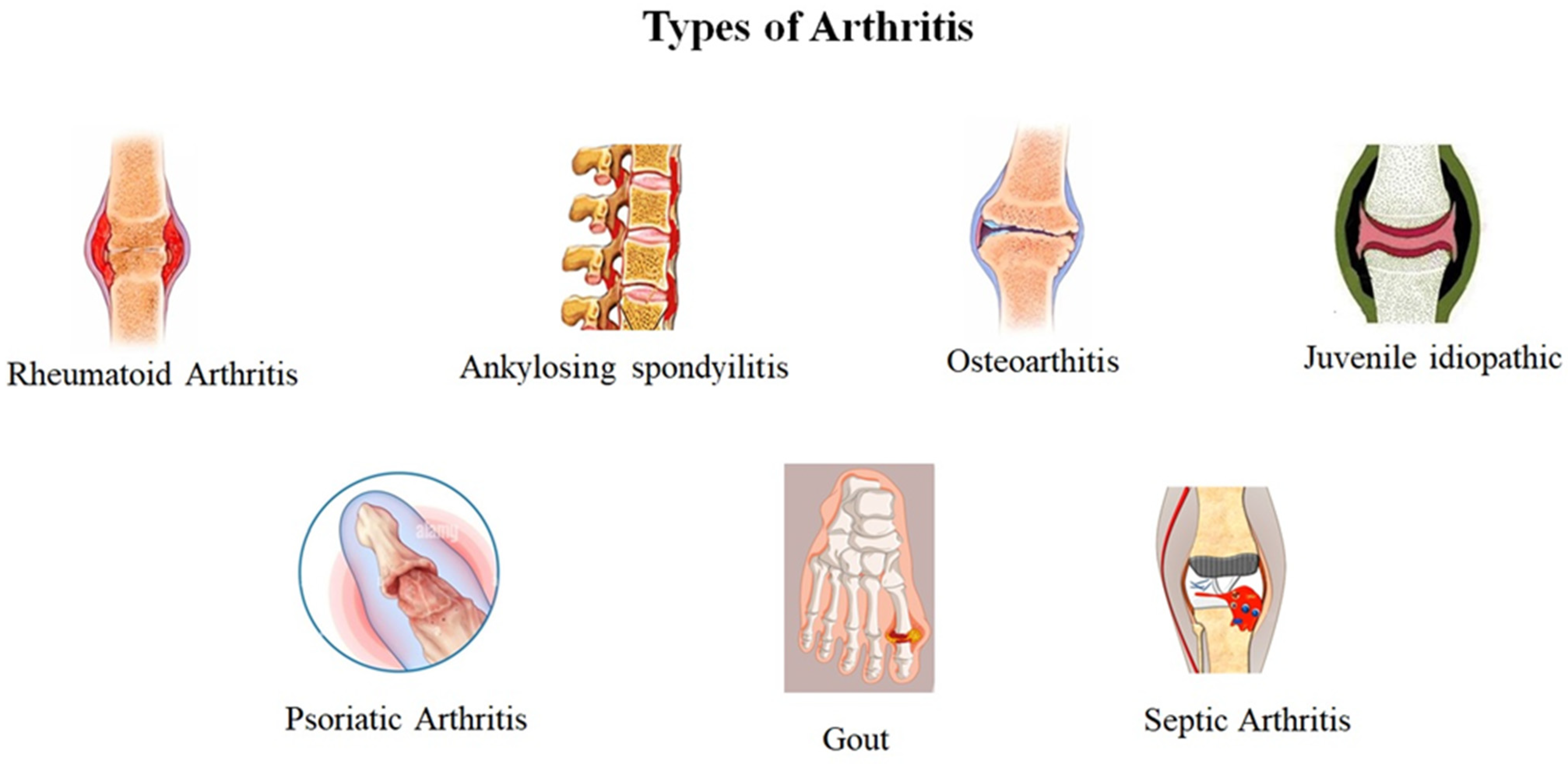 nard liječenje osteoartritisa terapijske vježbe za bolove u zglobovima koljena