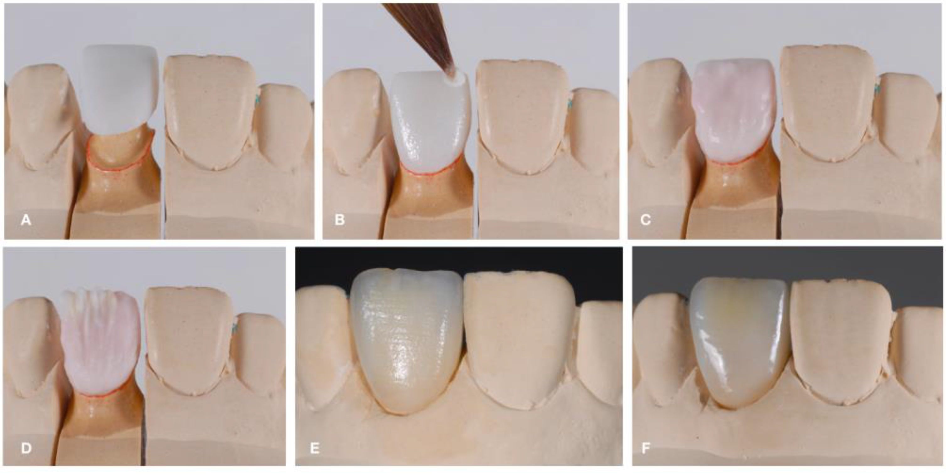 How to repair Porcelain or Ceramic crowns using Waldent Ceramic