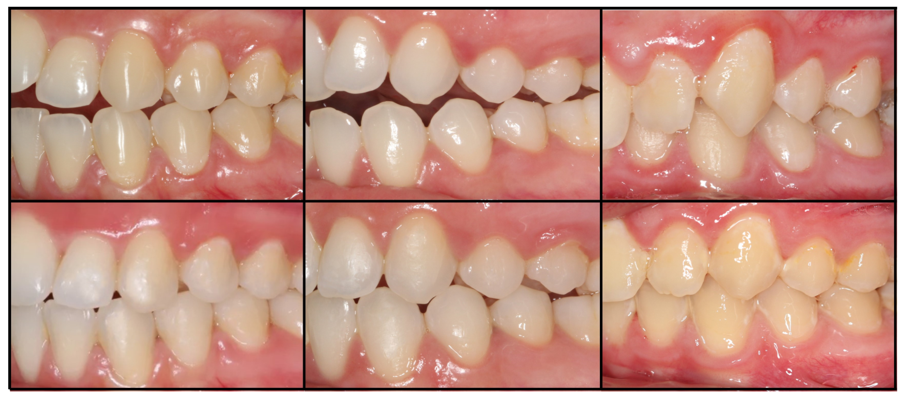 Coatings | Free Full-Text | Eighteen-Month Orthodontic Bracket Survival  Rate with the Conventional Bonding Technique versus RMGIC and V-Prep: A  Split-Mouth RCT