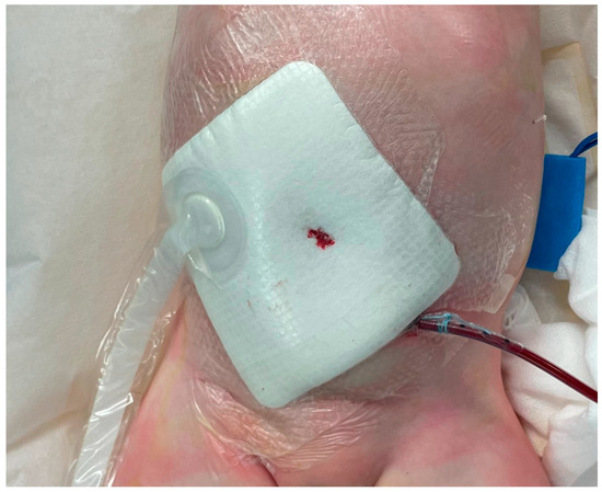 Multidisciplinary Management of Non-Healing Umbilical Ulcer in an