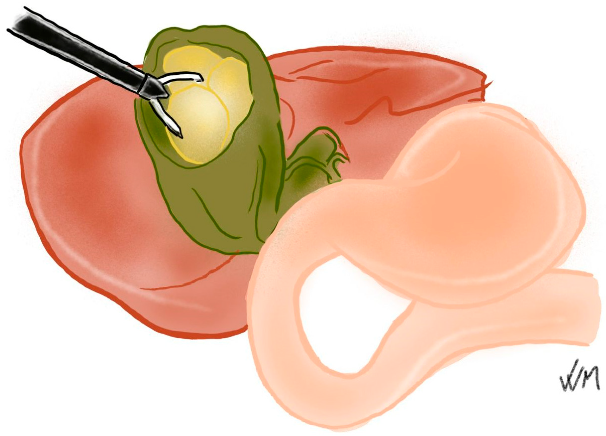 Complications 03 00002 g004b Complications 03 00002 g004b