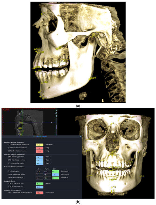 An Efficient Hybrid 3D Computer-Aided Cephalometric Analysis for ...