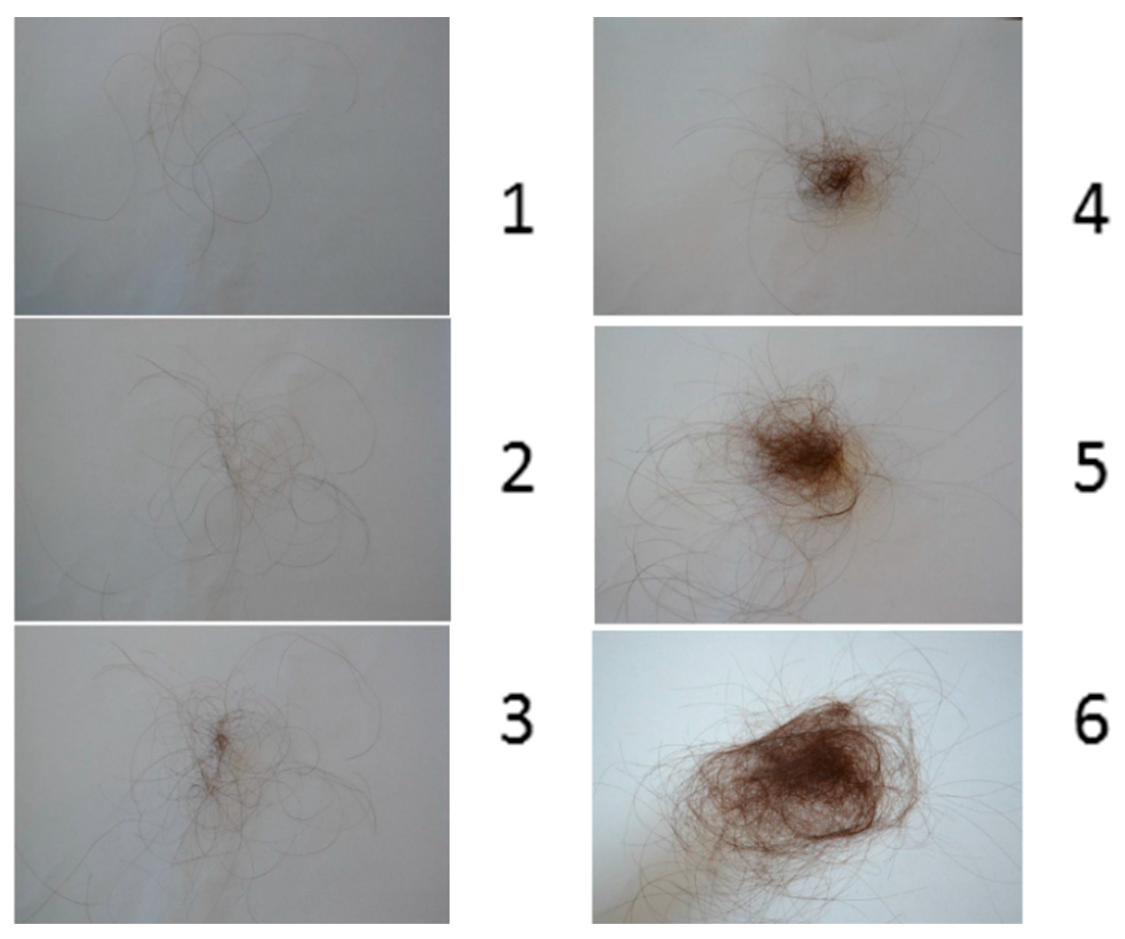 Telogen effluvium discount hair loss