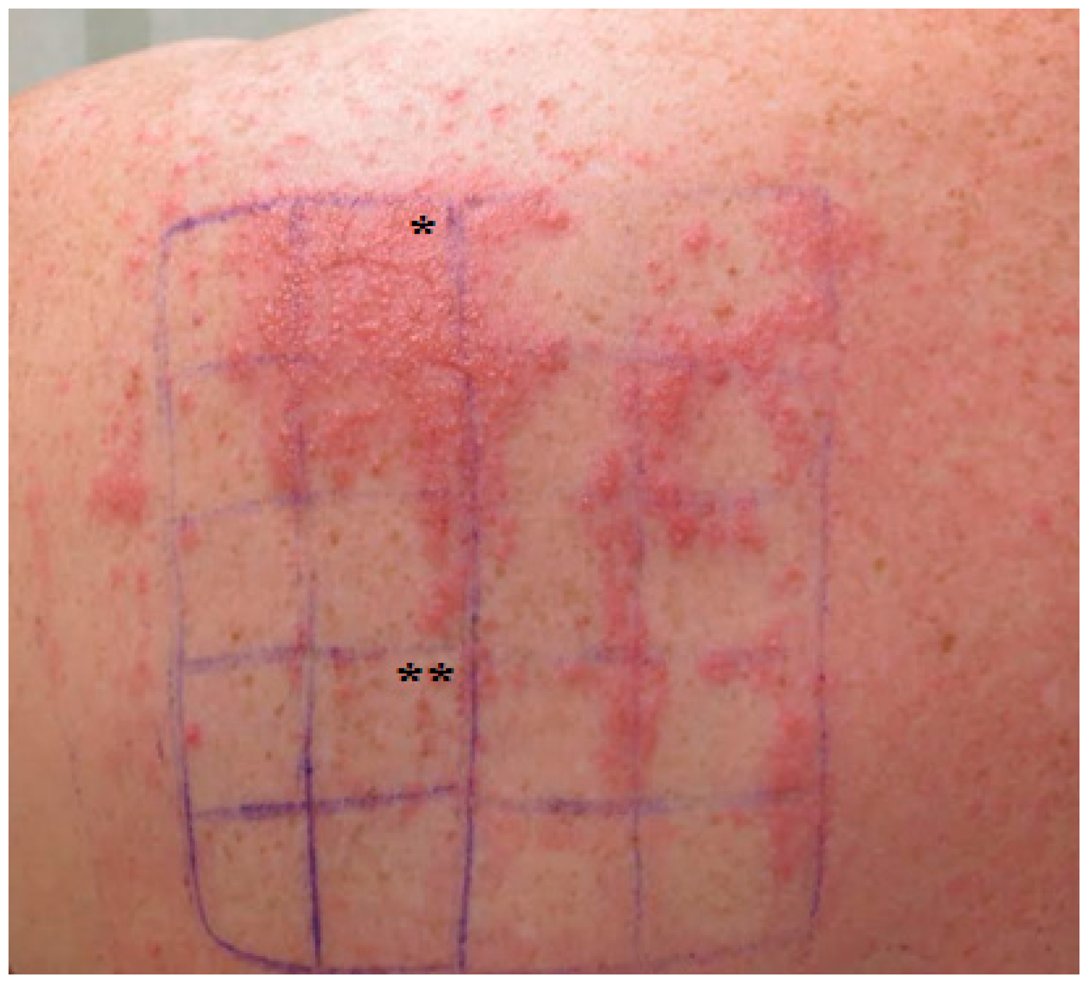 Contact Allergy to Castor Oil, but Not to Castor Wax