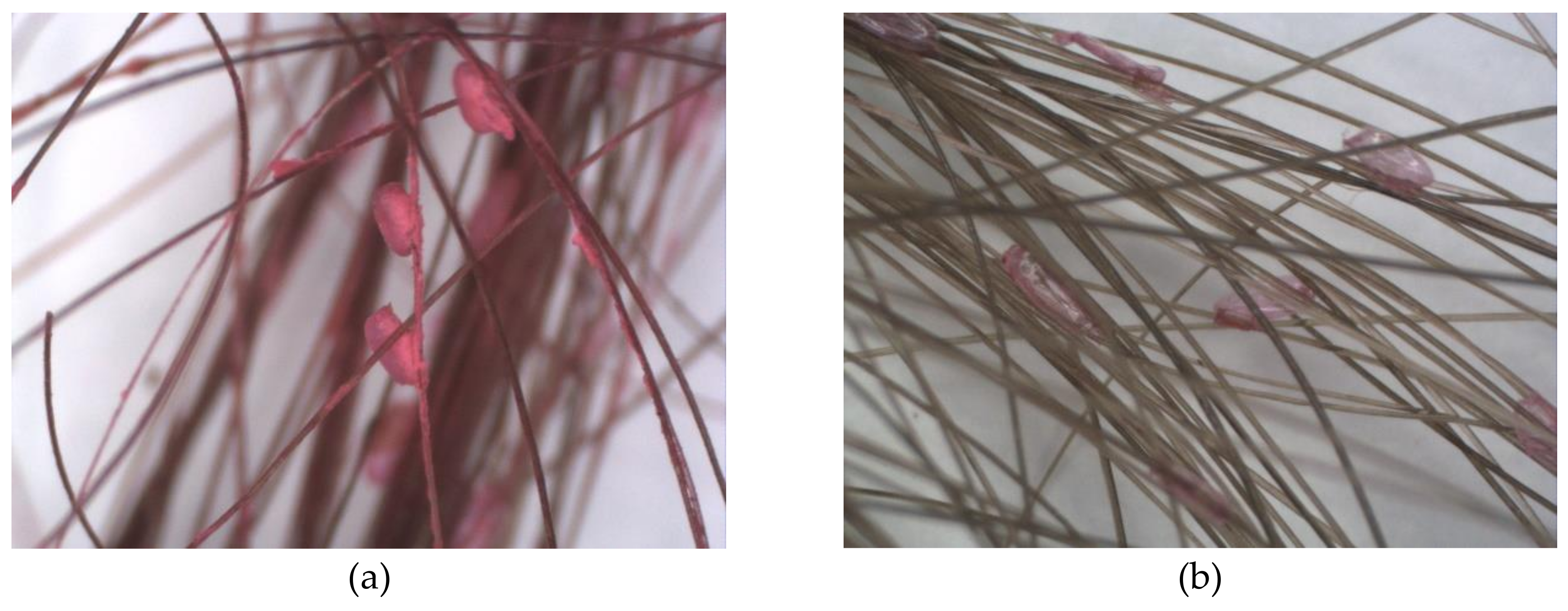 Treatment for head lice effective with one dose and no combing - Harvard  Health