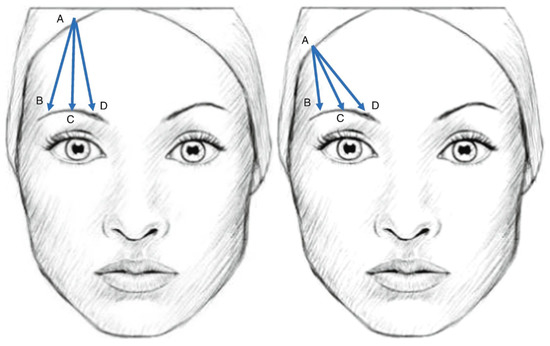 Continuous Brow Ridge Expert Opinion on Non-Surgical Eyebrow Lifting and Shaping Procedures