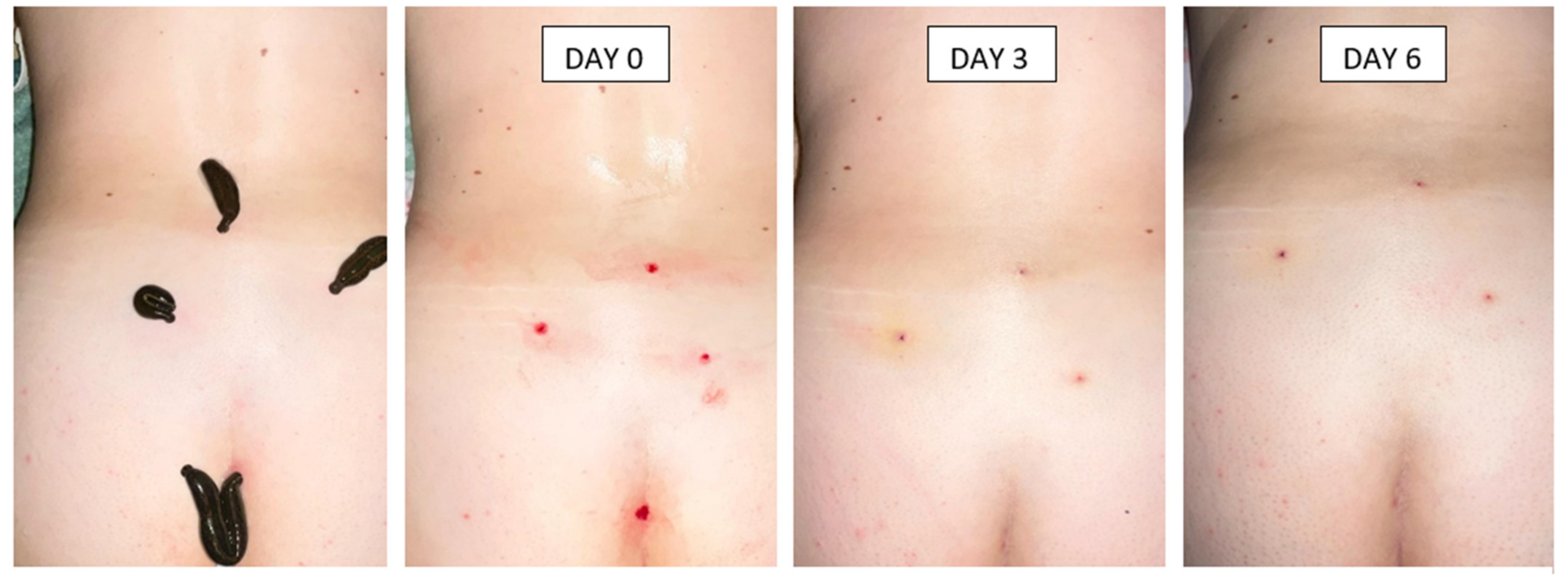 Cosmetics | Free Full-Text | Case Reports and Experts Opinions about  Current Use of Leech Therapy in Dermatology and Cosmetology