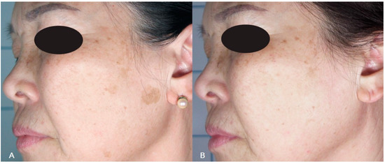 Q-Switched Nd:YAG Laser to Manage Hyperpigmentation in