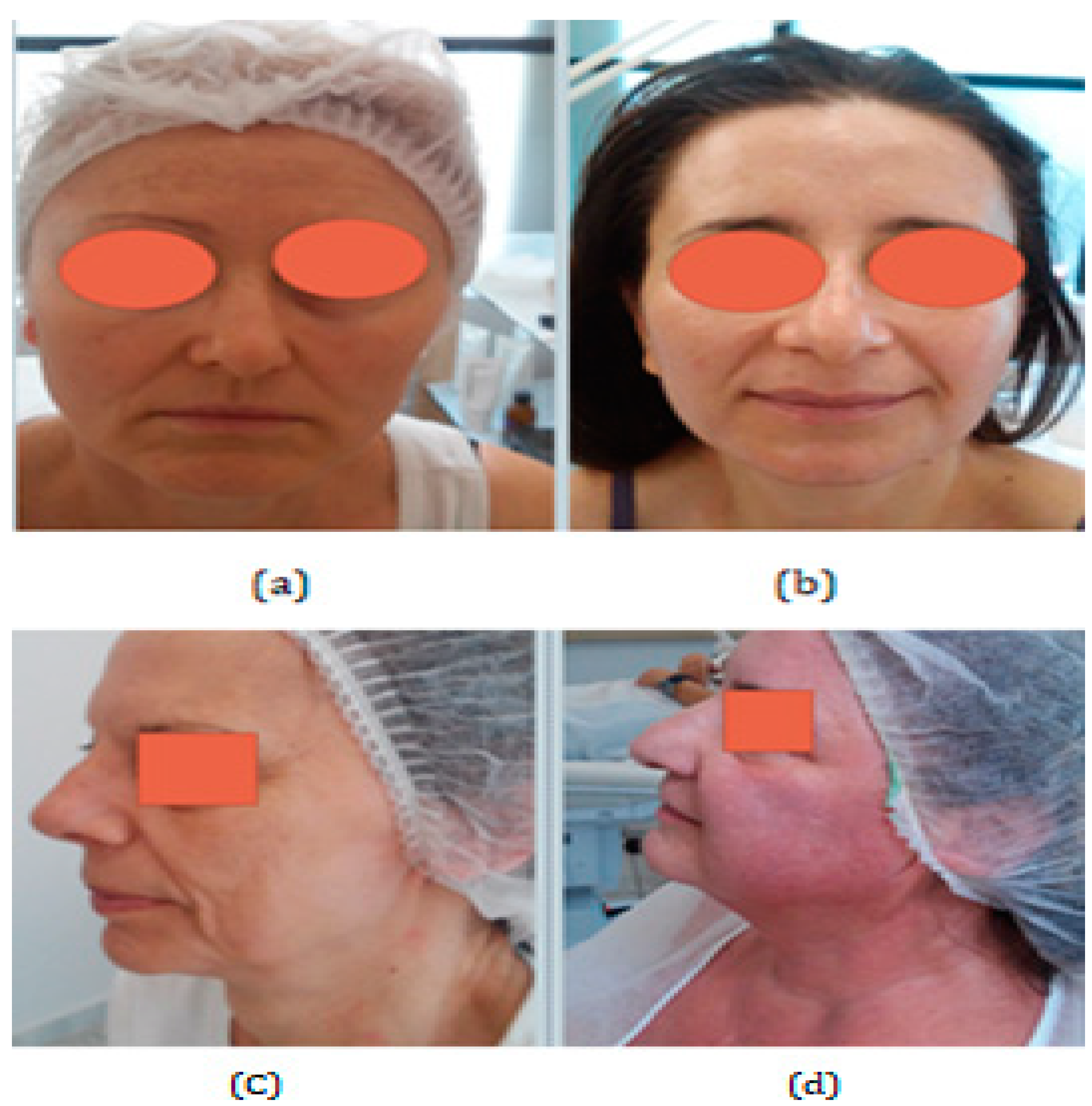 Cosmetics free full text aging and the impact of solar ultraviolet