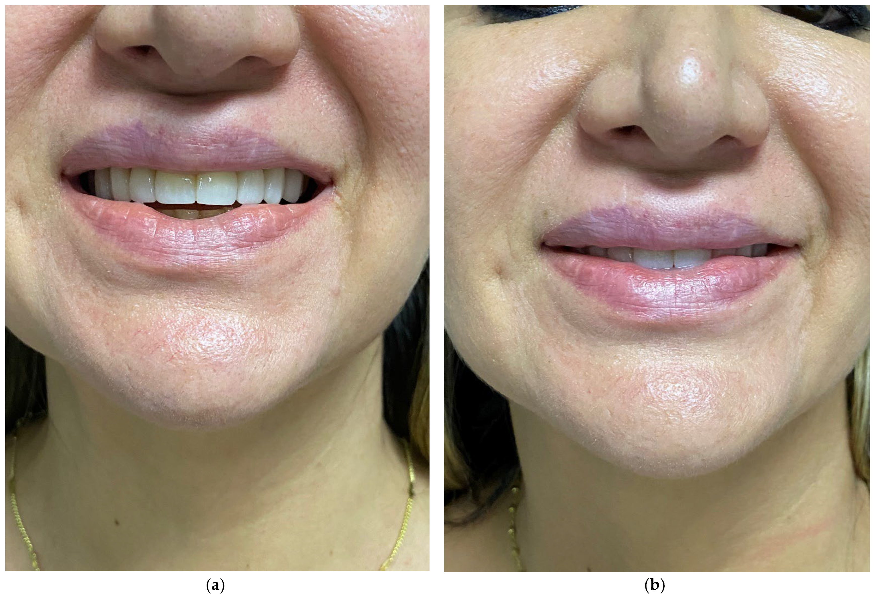 Cosmetics | Free Full-Text | Hyaluronic Acid in Facial 
