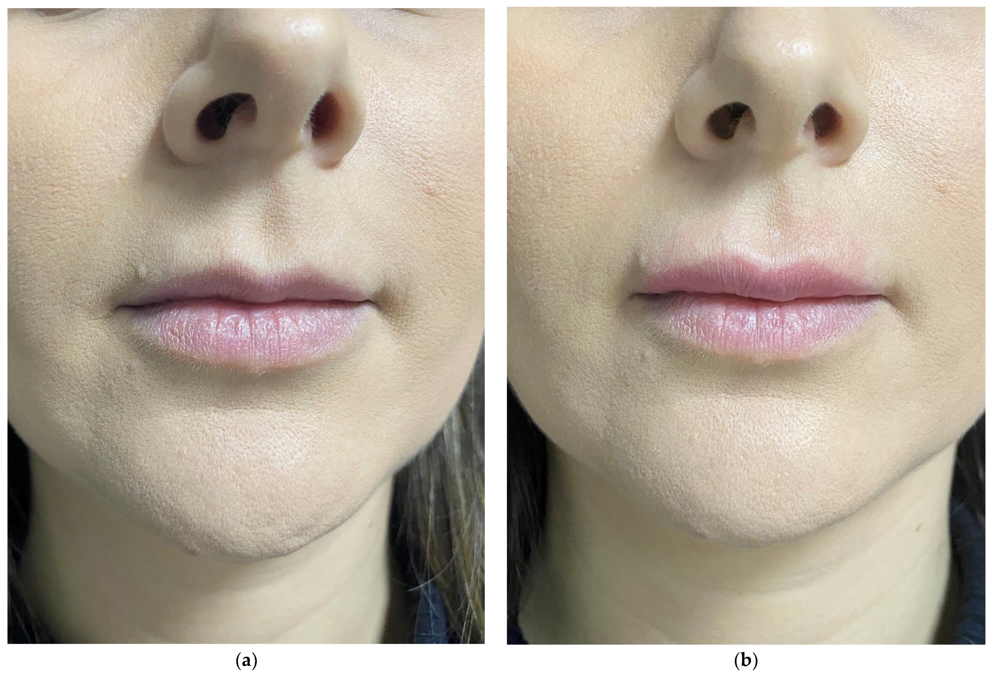 Cosmetics | Free Full-Text | Hyaluronic Acid in Facial 