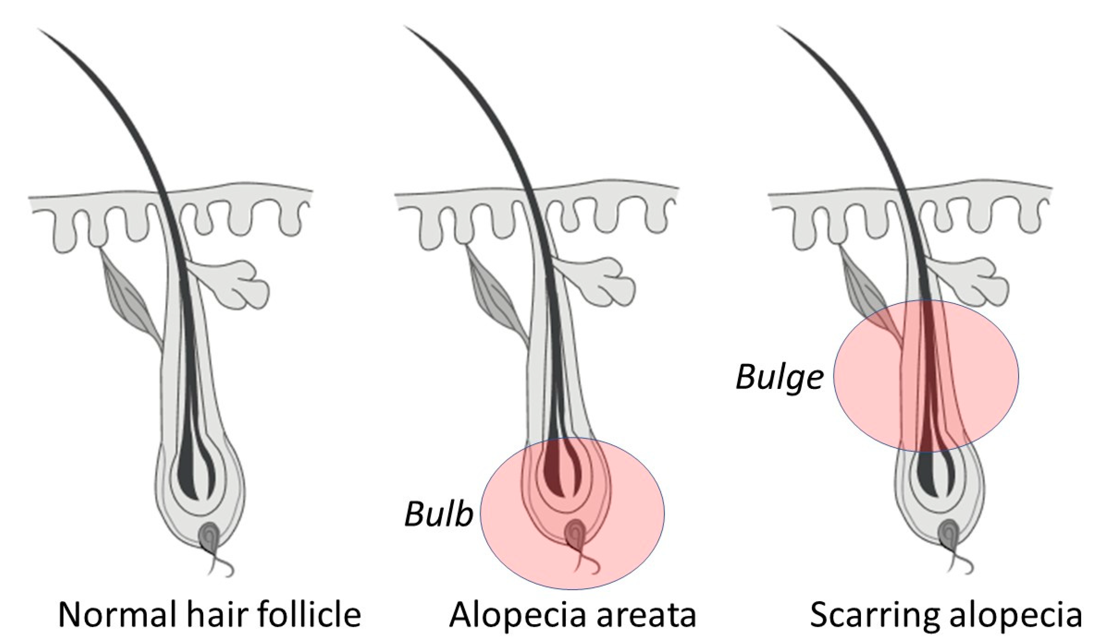 Androgenetic Alopecia | Tunio Aesthetics