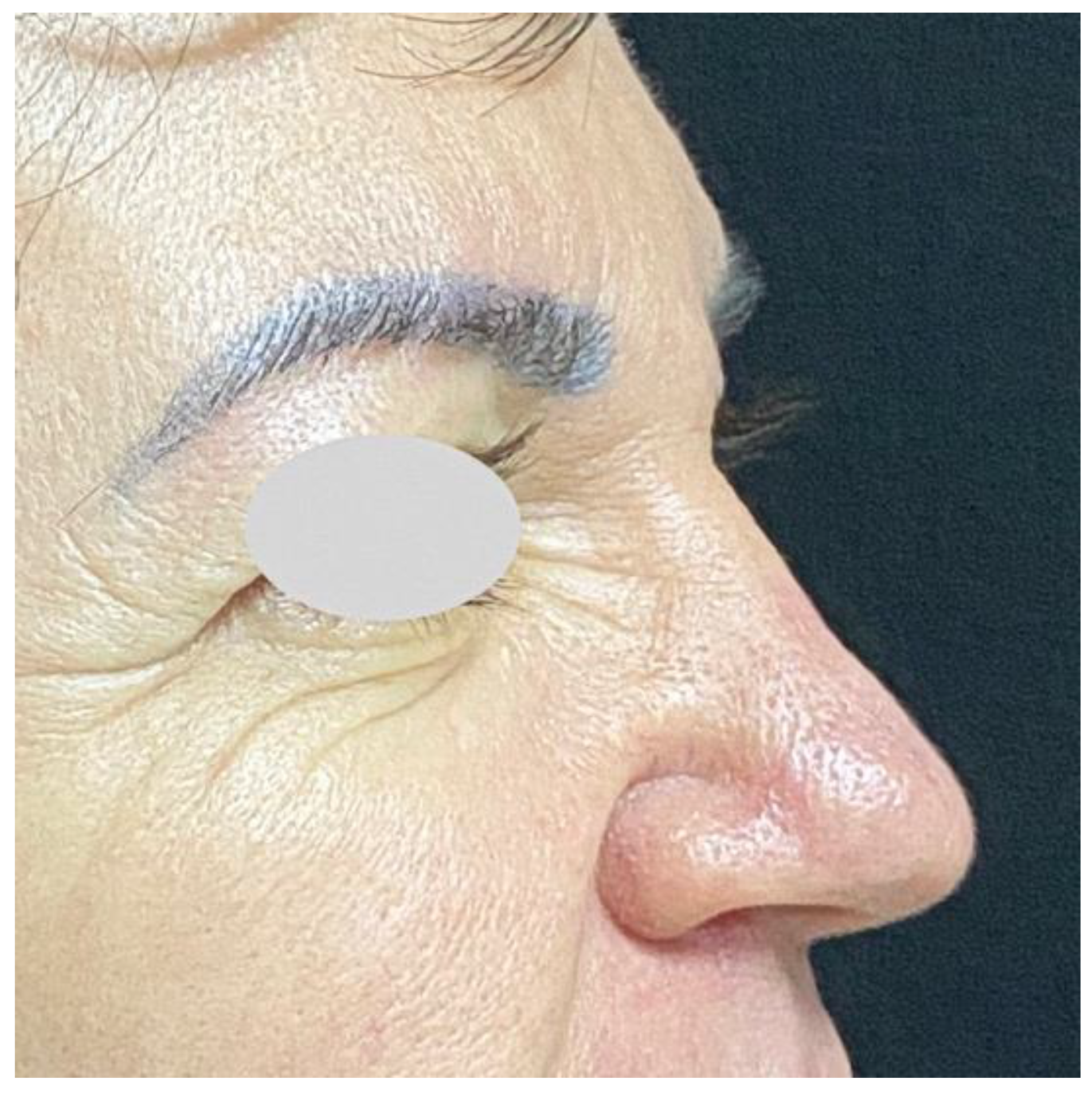Cosmetics Free Full-Text Filler Migration after Facial Injectionandmdash;A Narrative Review pic photo