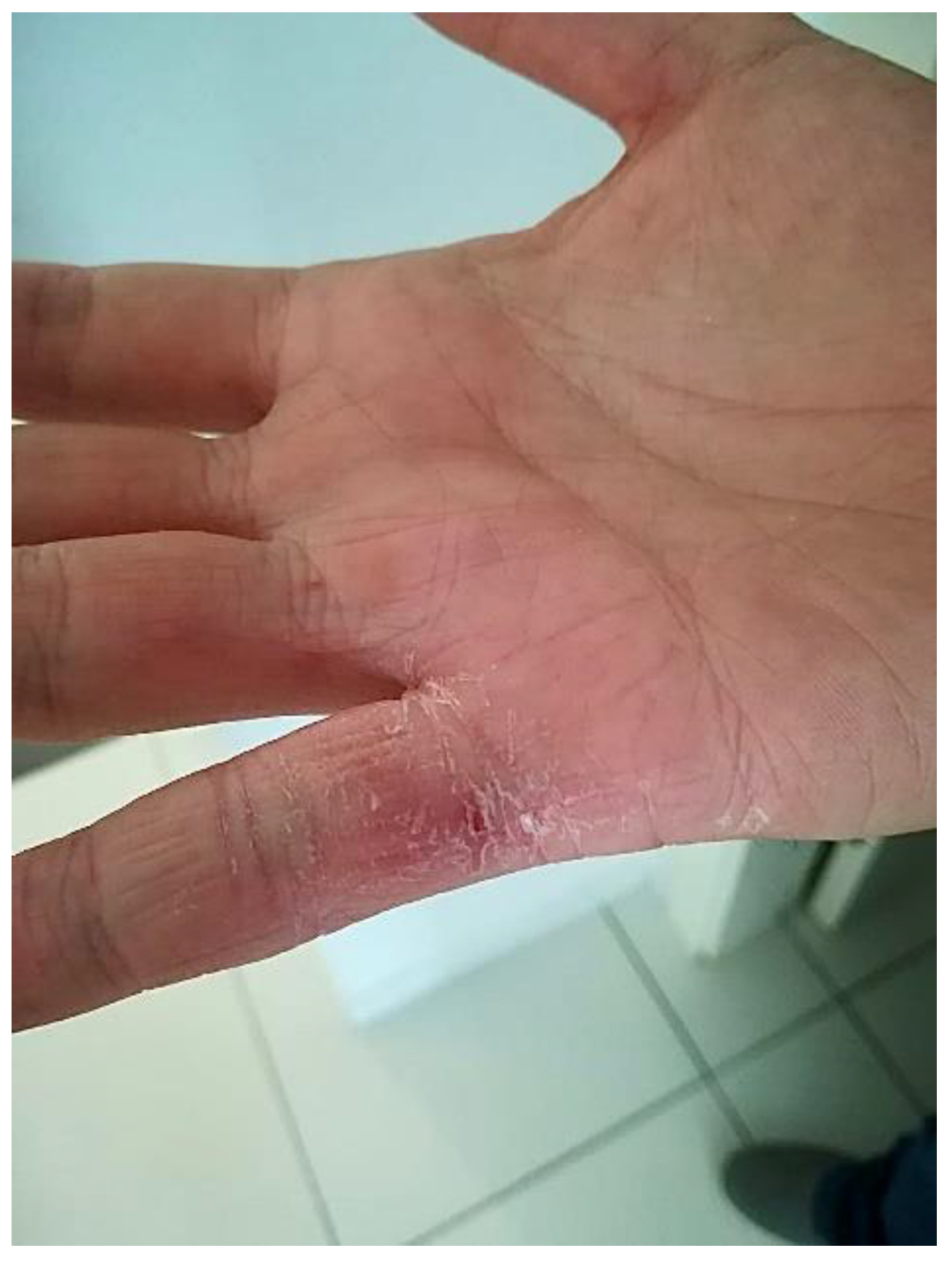 Cosmetics Free Full Text Work Related Hand Eczema in