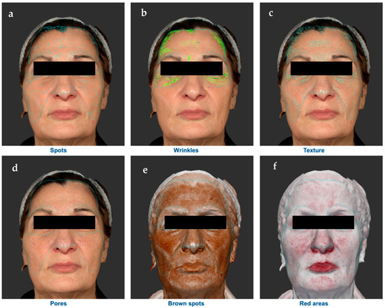 Skin Anti-Aging Effect of Oral Vitamin A Supplementation in 