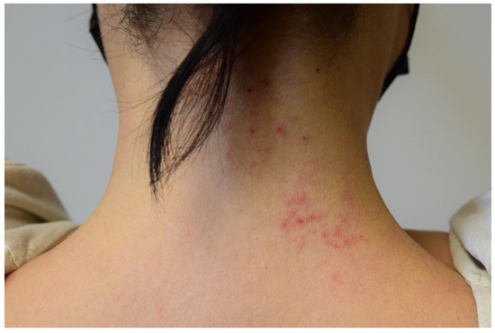 Contact Dermatitis Due to Hair Care Products A Comprehensive Review