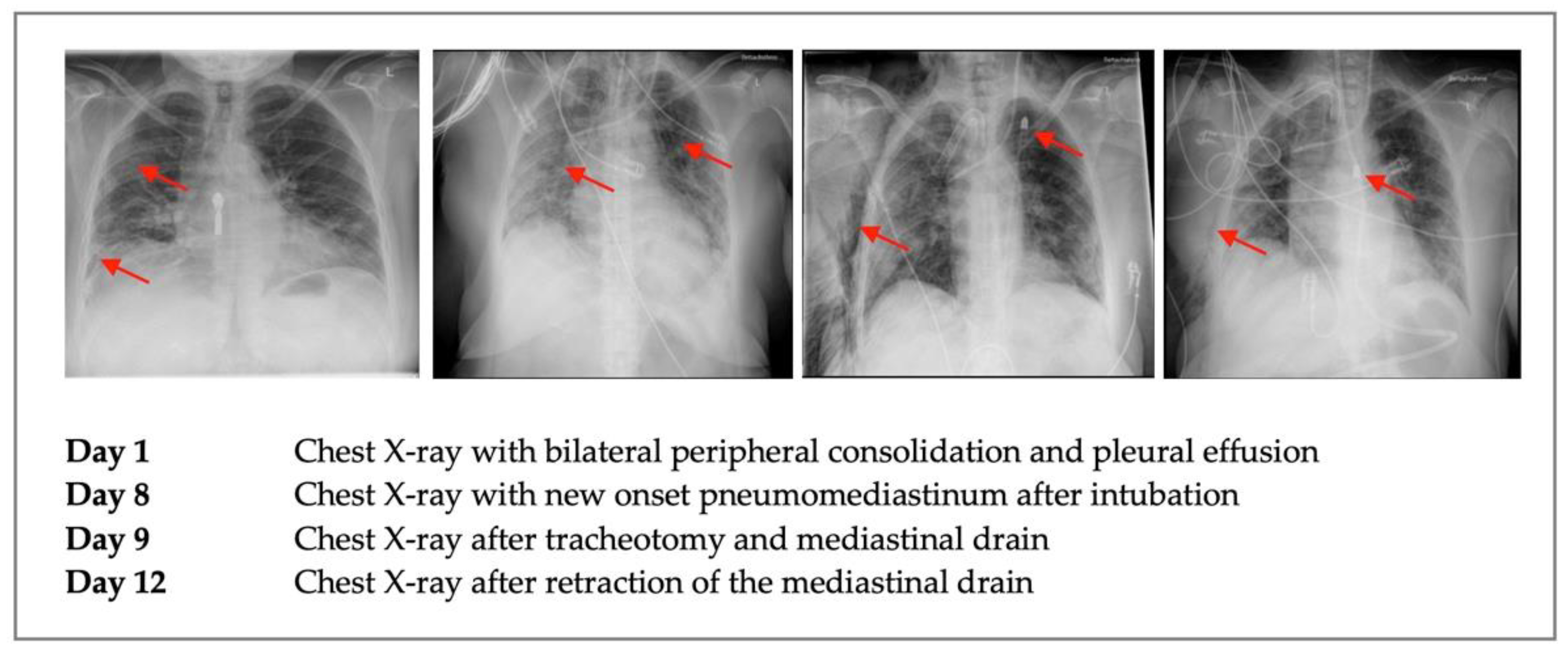 COVID | Free Full-Text | Survival by Mediastinal Chest Drain Due to  Pneumomediastinum Resulting from COVID-19