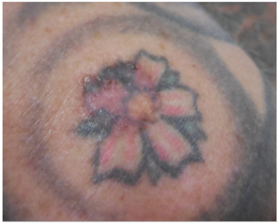 Infected Tattoo: Causes, Stages, & How To Identify It