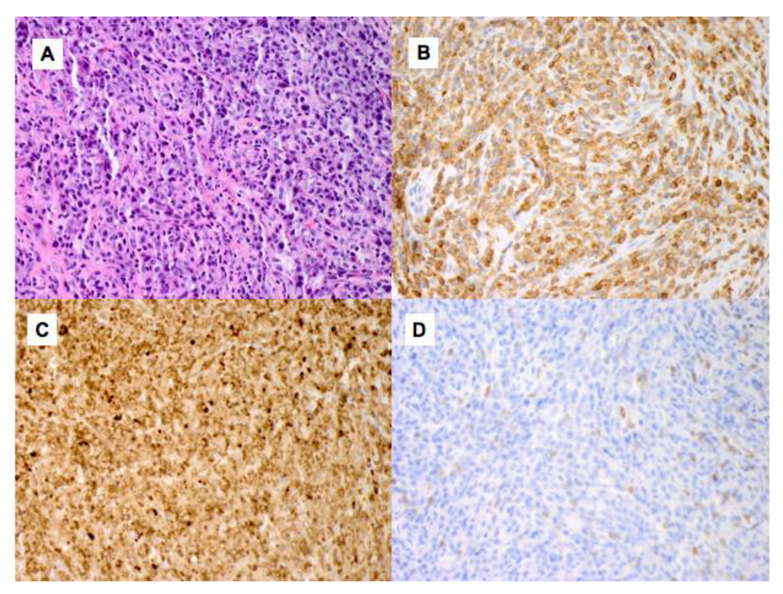 Durable Response to Brentuximab Vedotin Plus