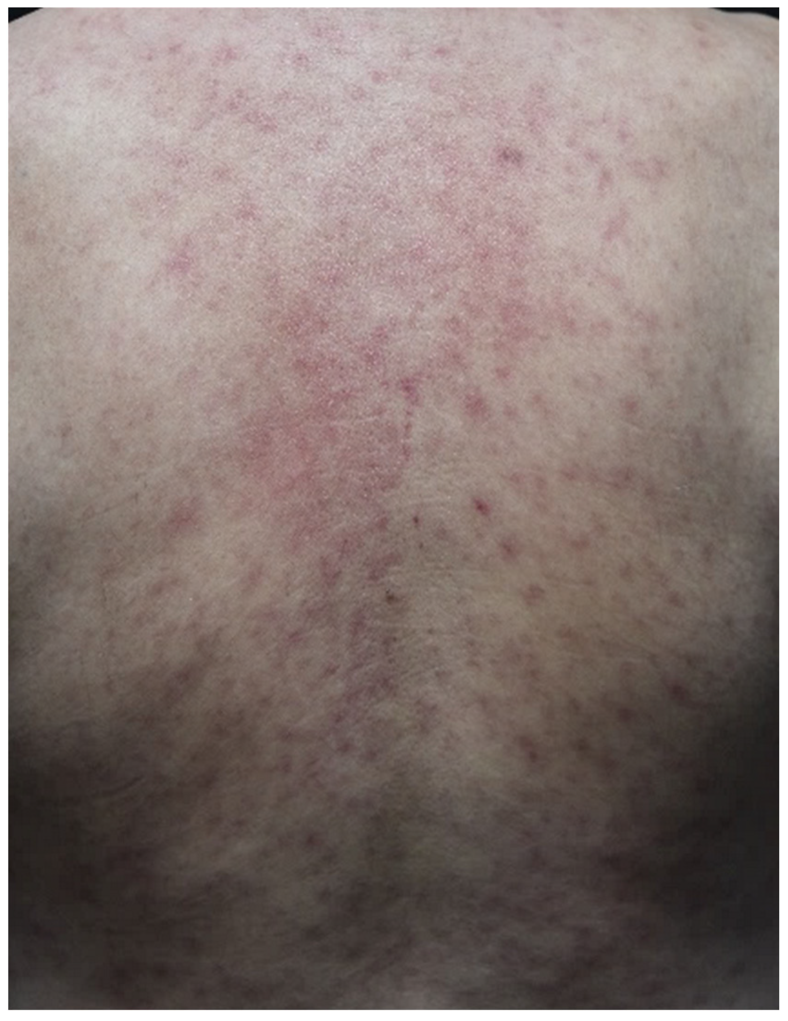 can neurontin cause rash