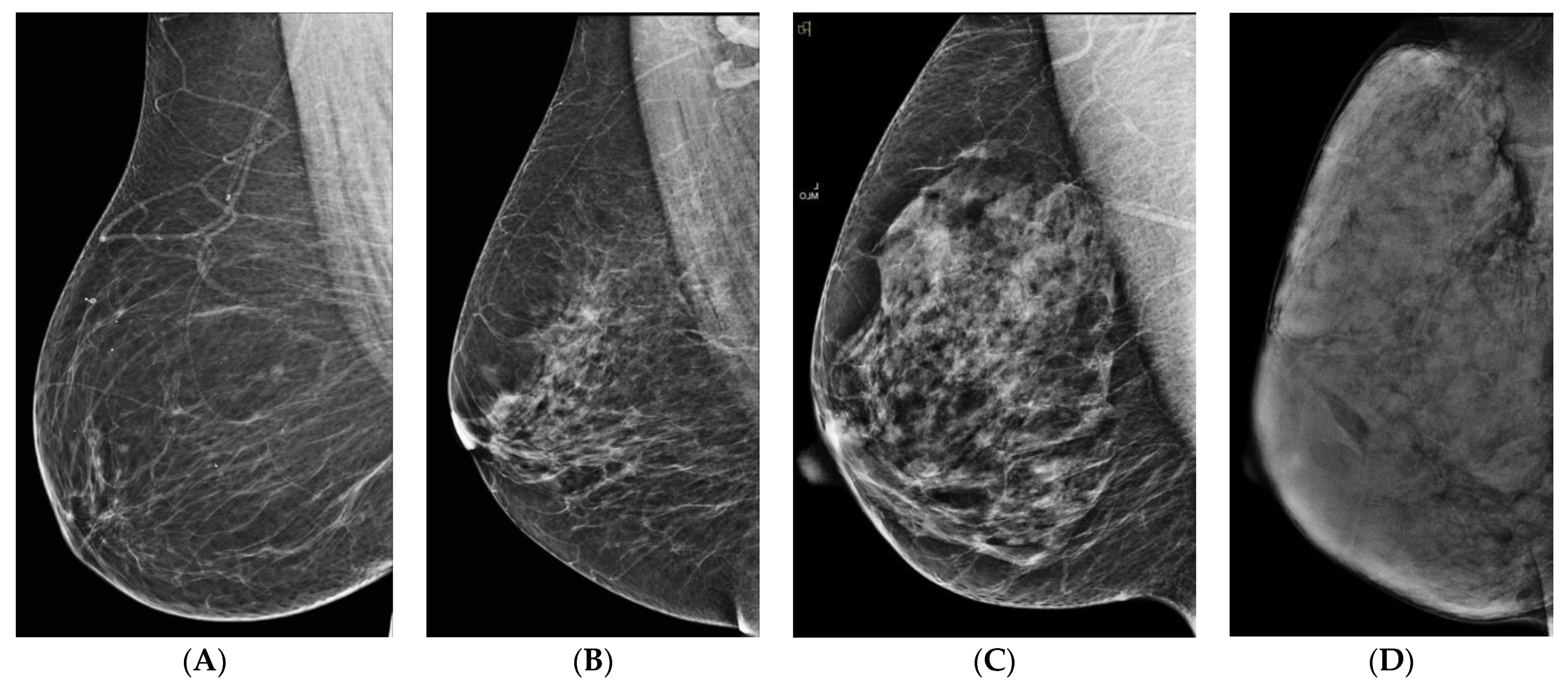 Recall rates in women by breast size and by age group. Age Women with