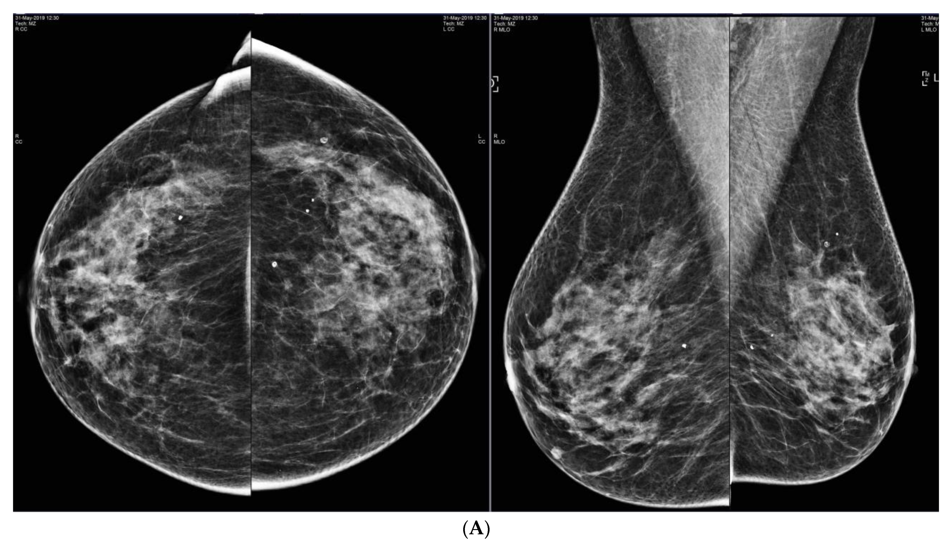 breast cancer digital mammogram