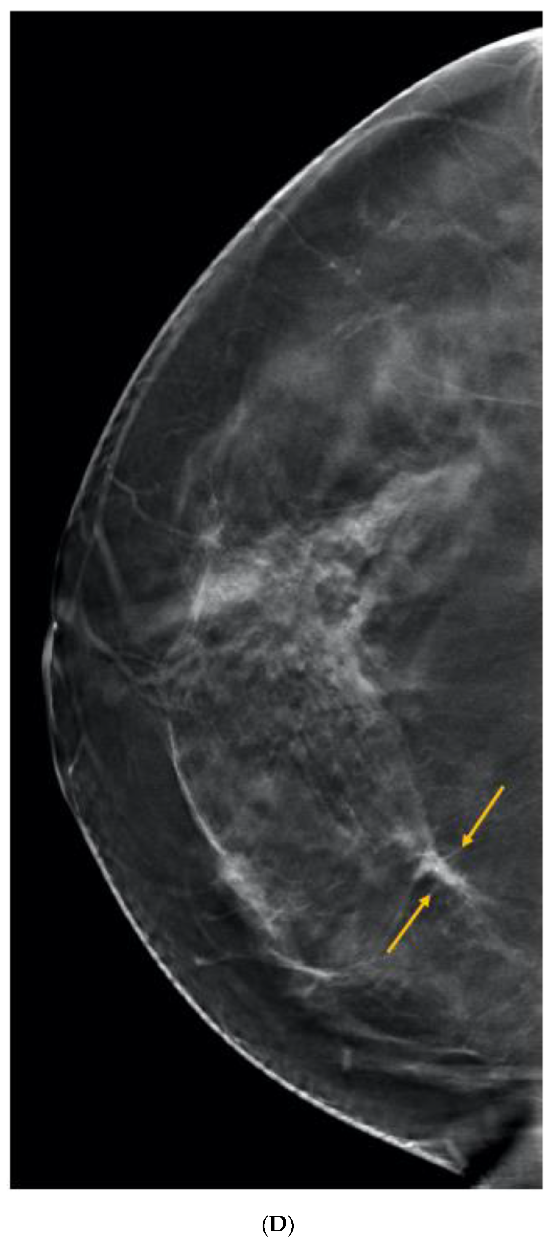 Curroncol 29 00291 g005d Curroncol 29 00291 g005d