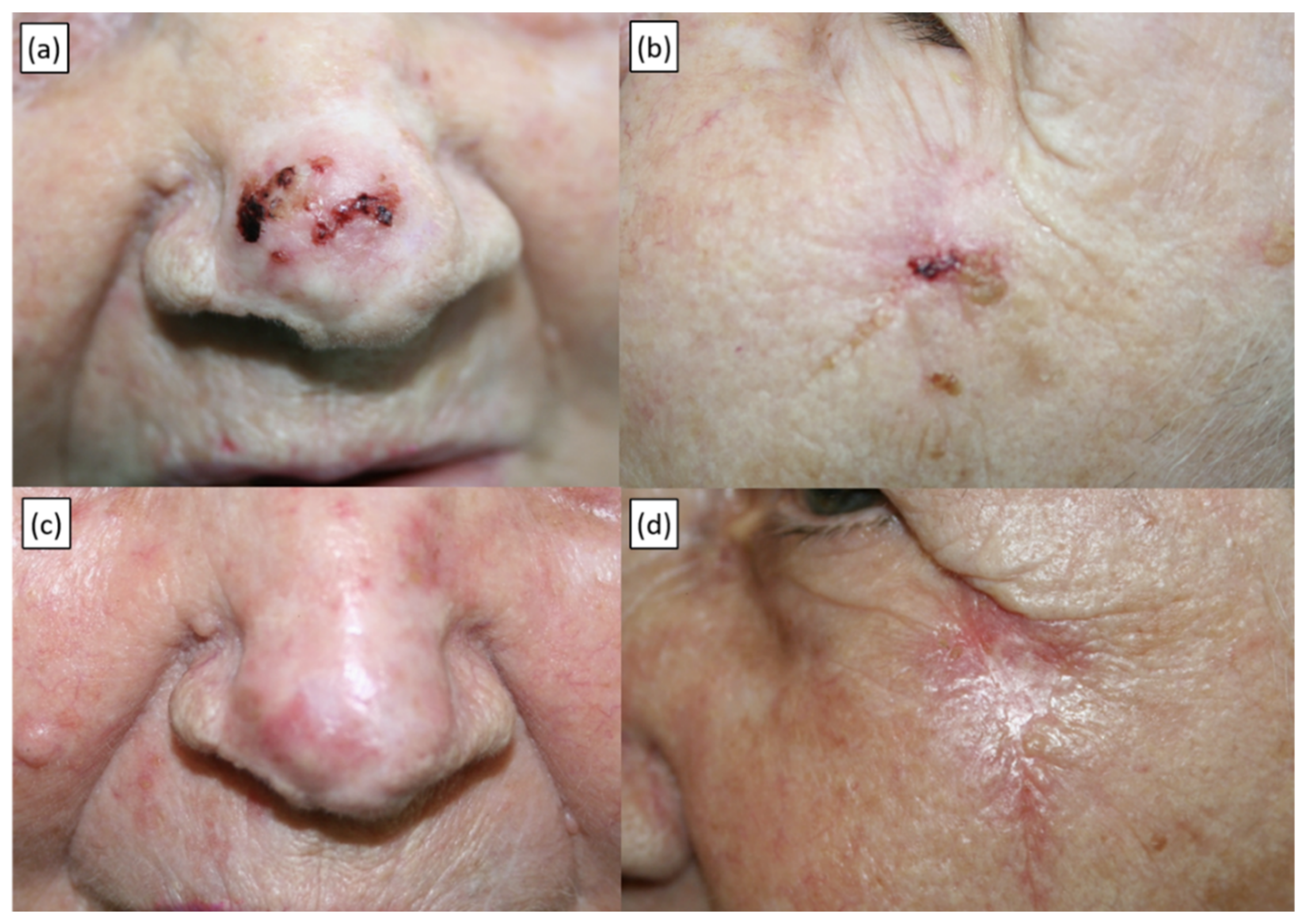 basal cell carcinoma nose scar