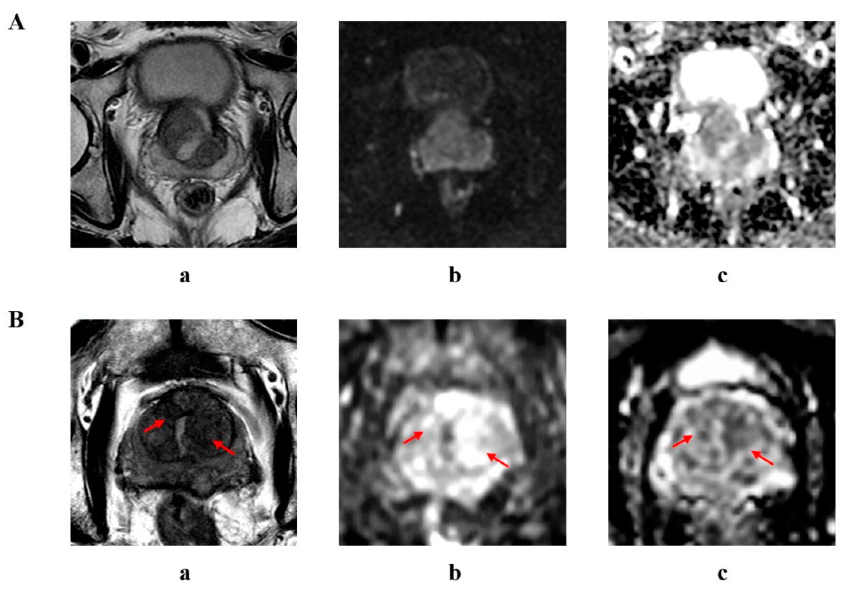 Current Oncology Free Full Text The Diagnostic Value Of PI RADS V2