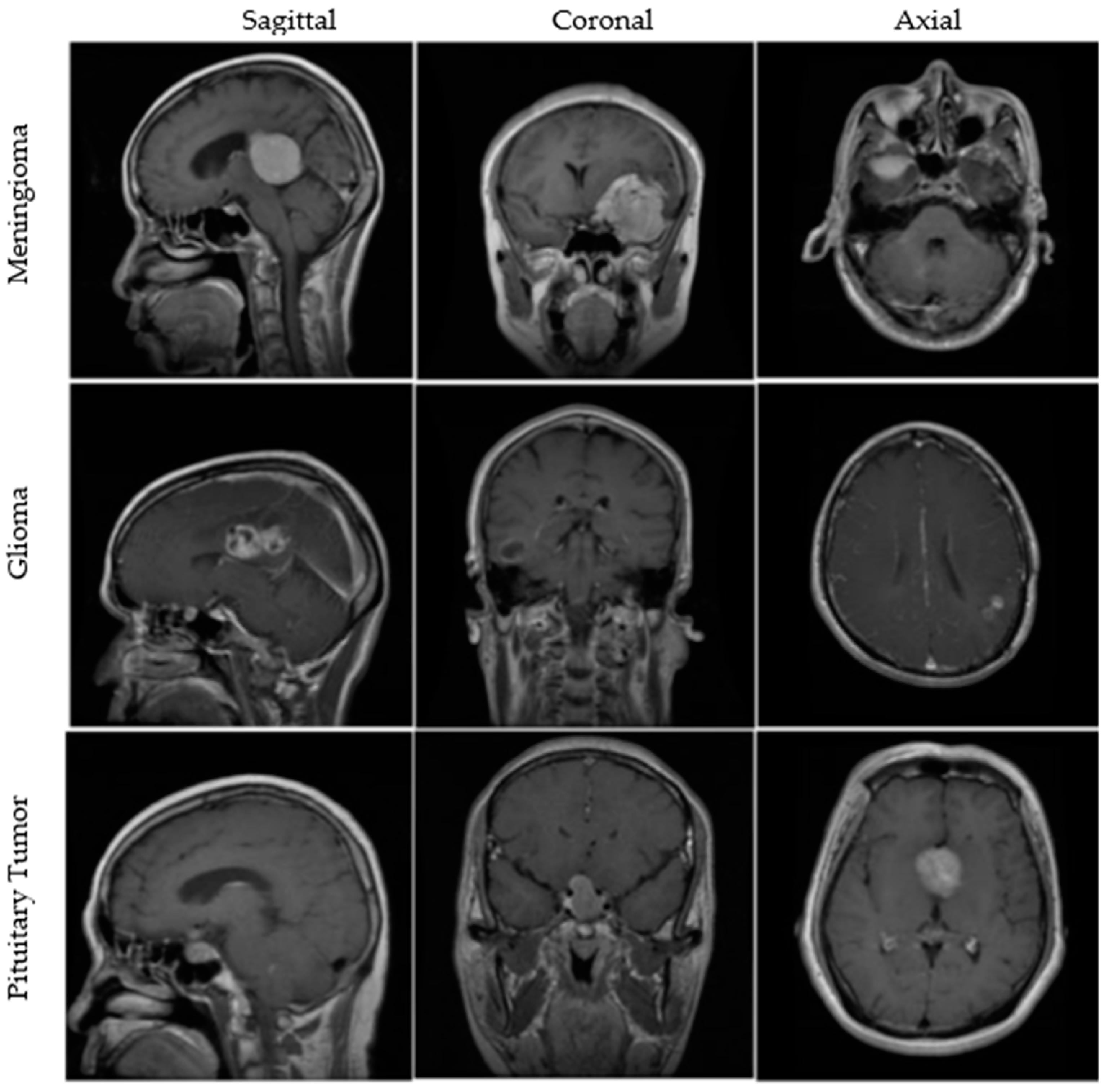 brain scan with tumor