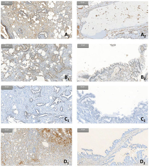 Complement and Fungal Dysbiosis as Prognostic Markers and