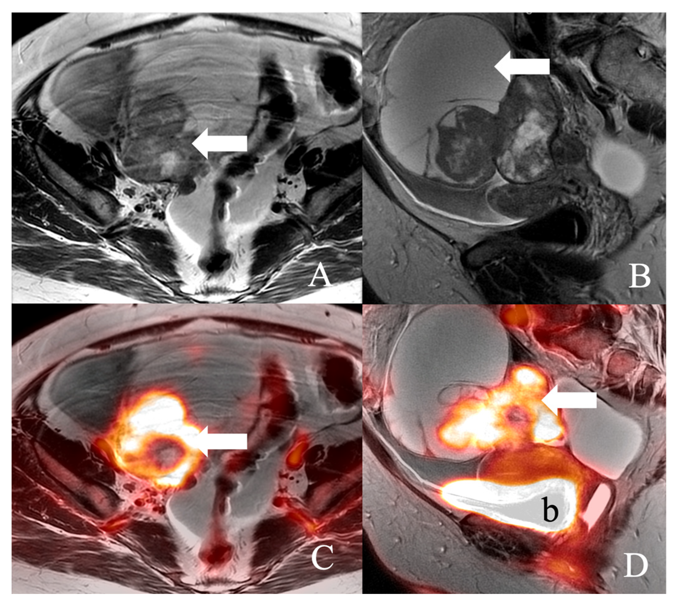 Current Update on PET/MRI in Gynecological Malignancies—A