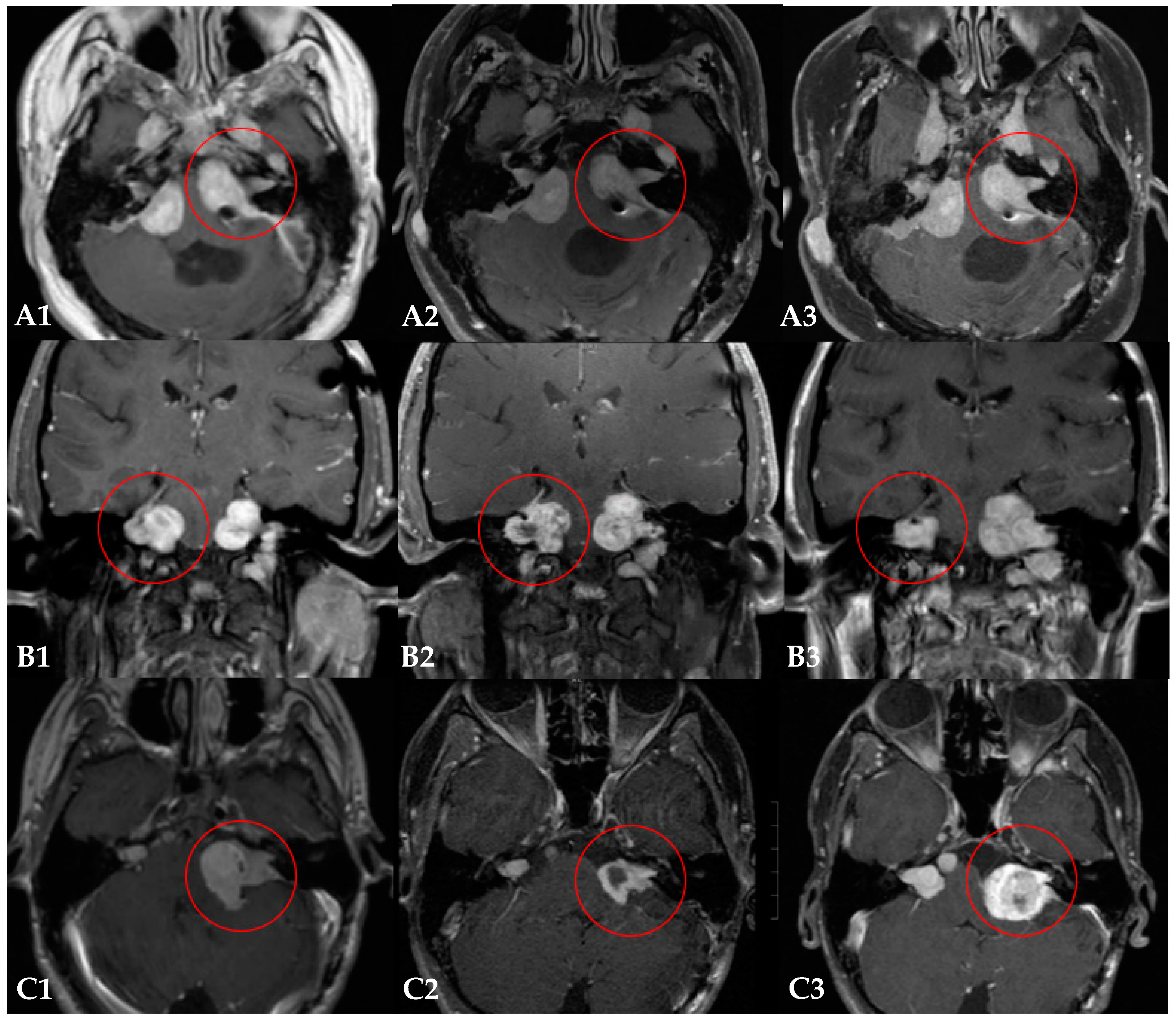 Current Oncology Free FullText Proton Radiotherapy for Vestibular