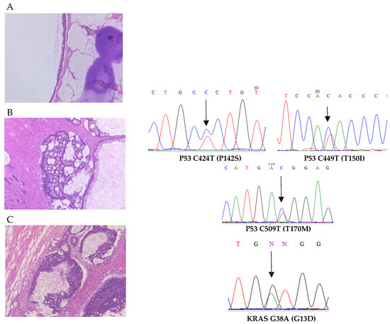 Histological And Genetic Diversity In Ovarian Mucinous Carcinomas A Histological And Genetic Diversity In Ovarian Mucinous Carcinomas A