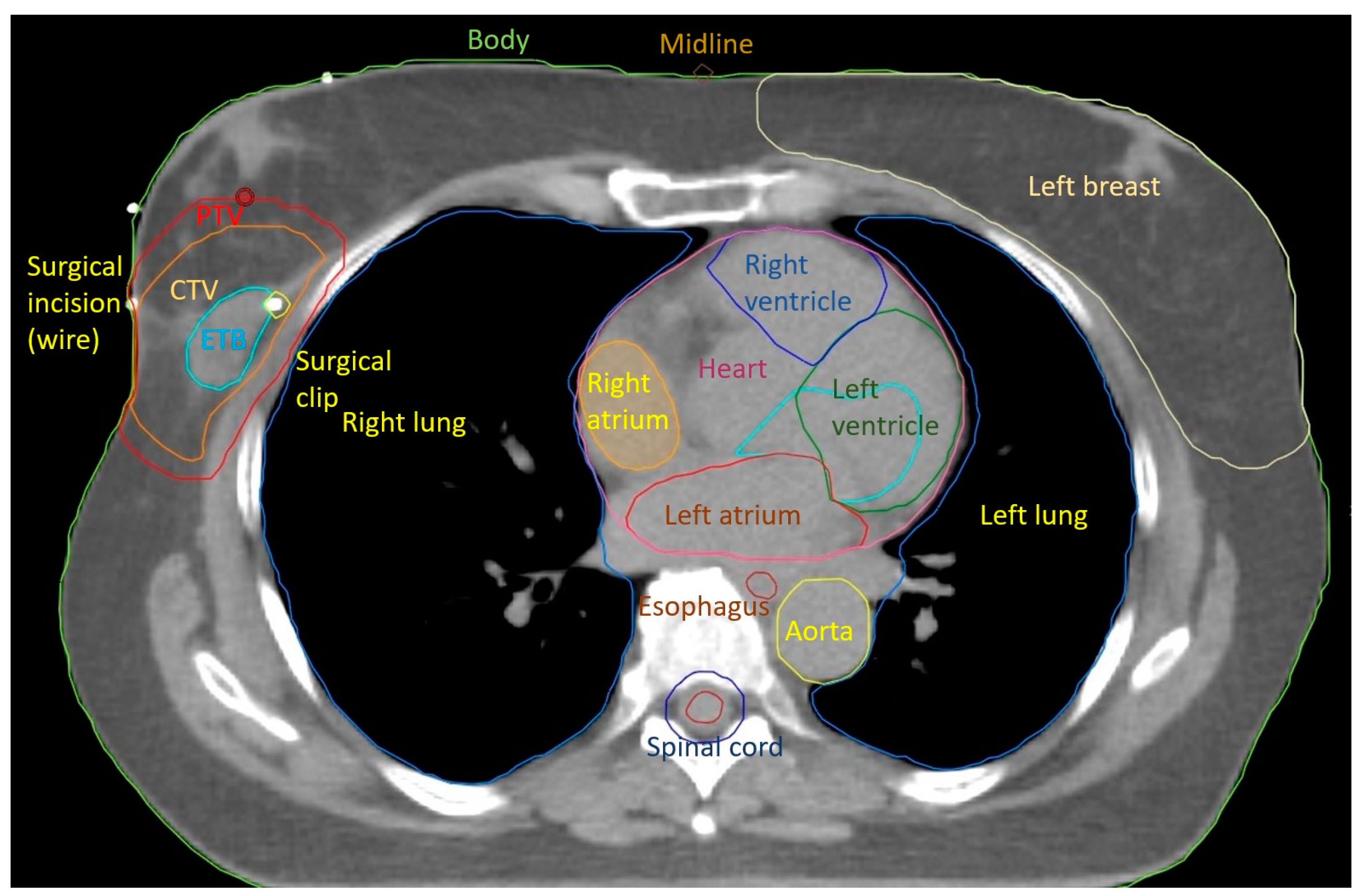 The Role of Adjuvant Radiotherapy in the Treatment of Breast