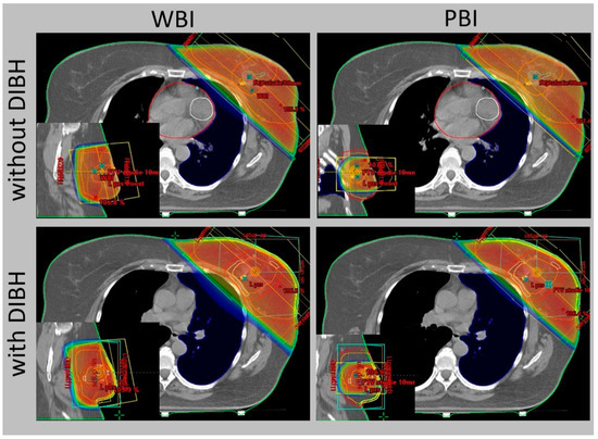 The Role of Adjuvant Radiotherapy in the Treatment of Breast
