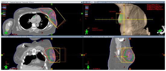 Personalized Radiation Therapy for Breast Cancer