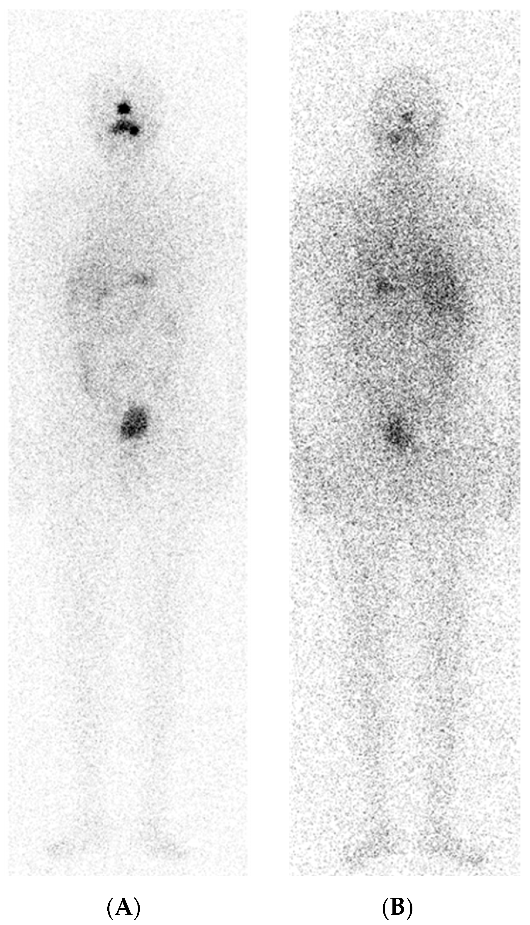 Current Advances in Radioactive Iodine-Refractory