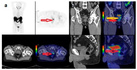 The Relationship between D’Amico and ISUP Risk Classifications and 68Ga ...
