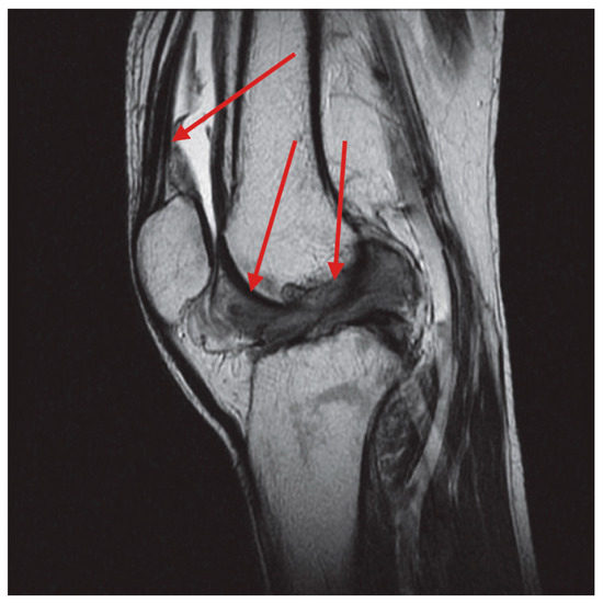 Diffuse-Type Tenosynovial Giant Cell Tumor of the Knee