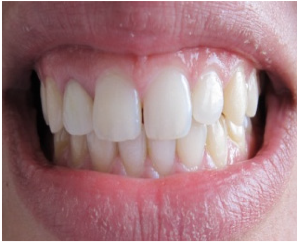 Dentistry Journal Free FullText Gingival Harmony in Anterior