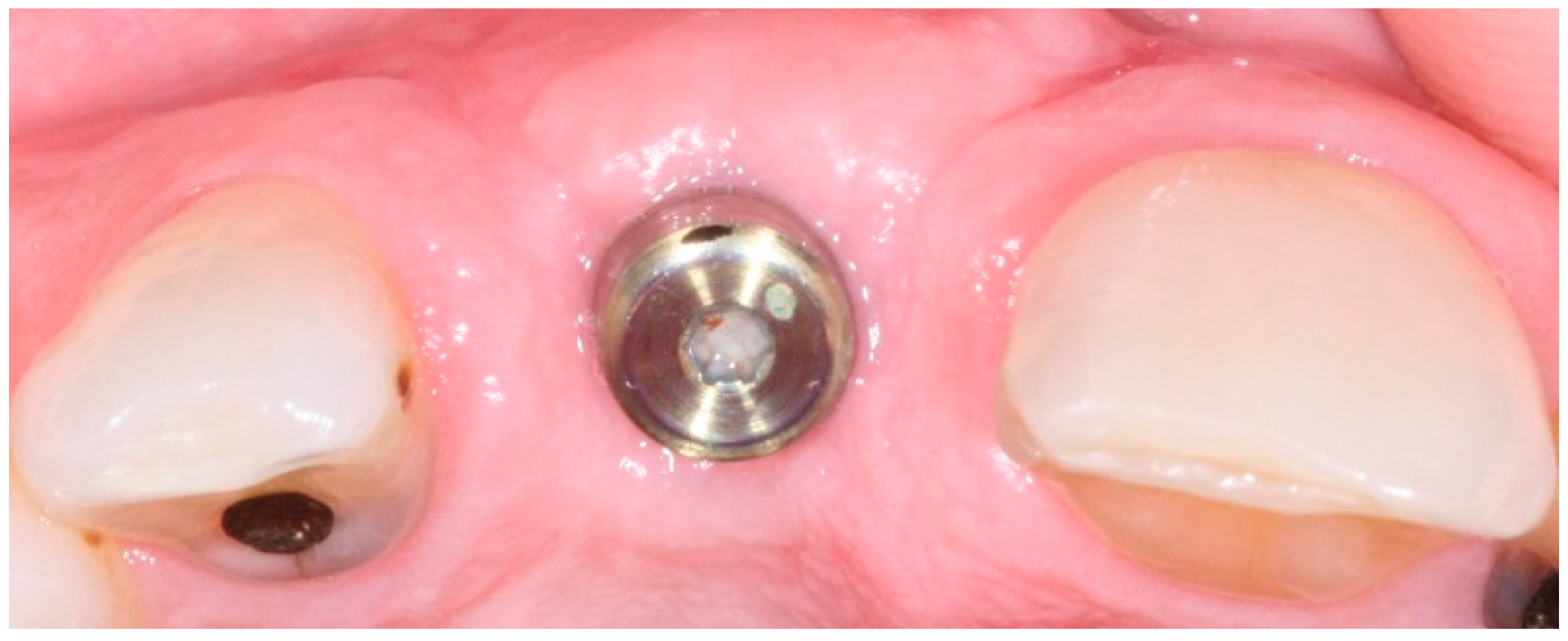 Dentistry Journal Free FullText A Simplified Technique for Implant