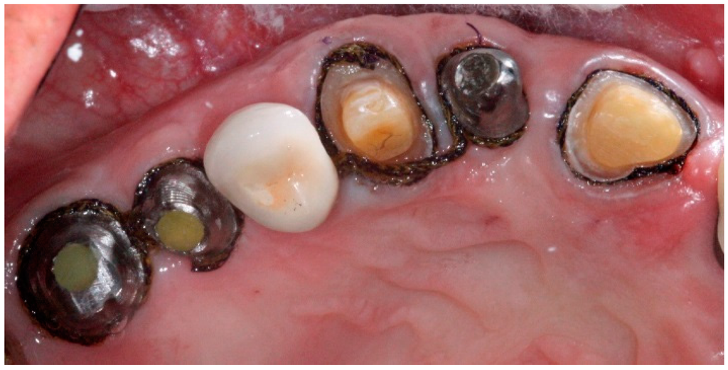 A Simplified Technique for ImplantAbutment Level Impression after Soft