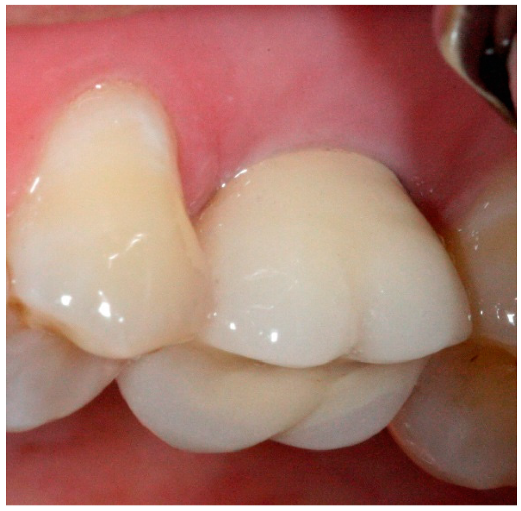 A Simplified Technique for ImplantAbutment Level Impression after Soft