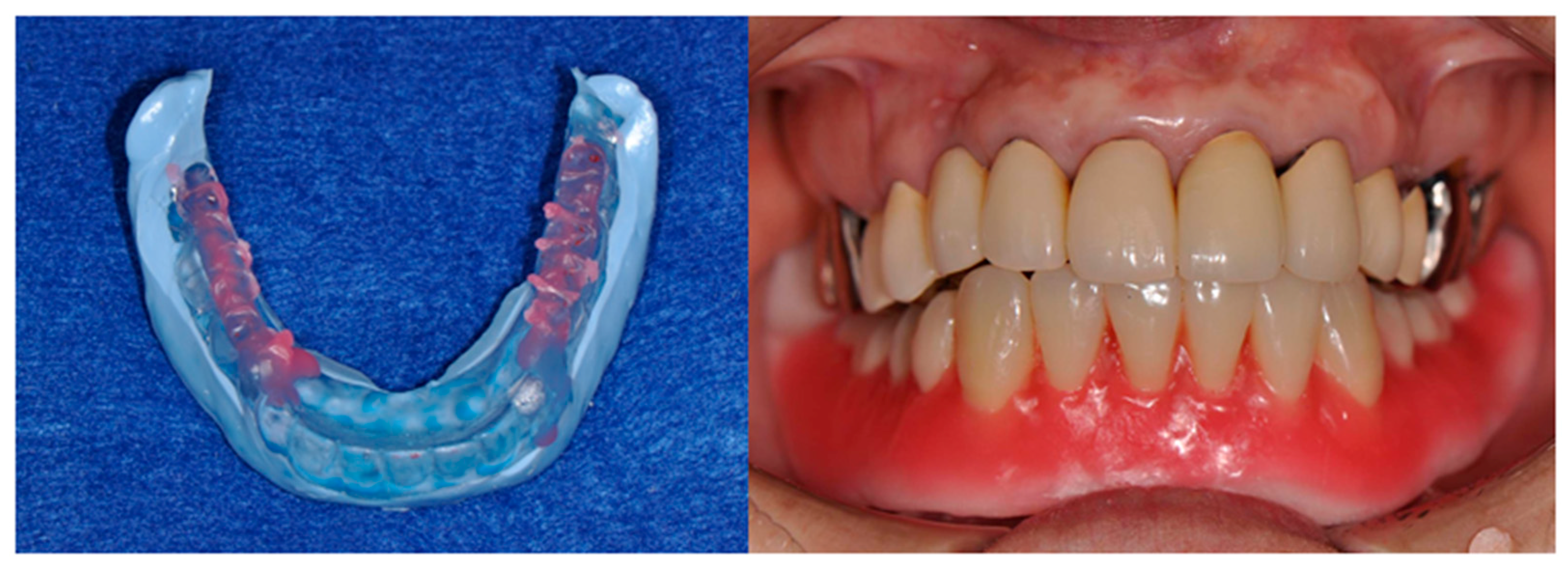 Dentures Cost In Japan  . Japan Has A Reputation For Having An Exorbitantly High Cost Of Living.