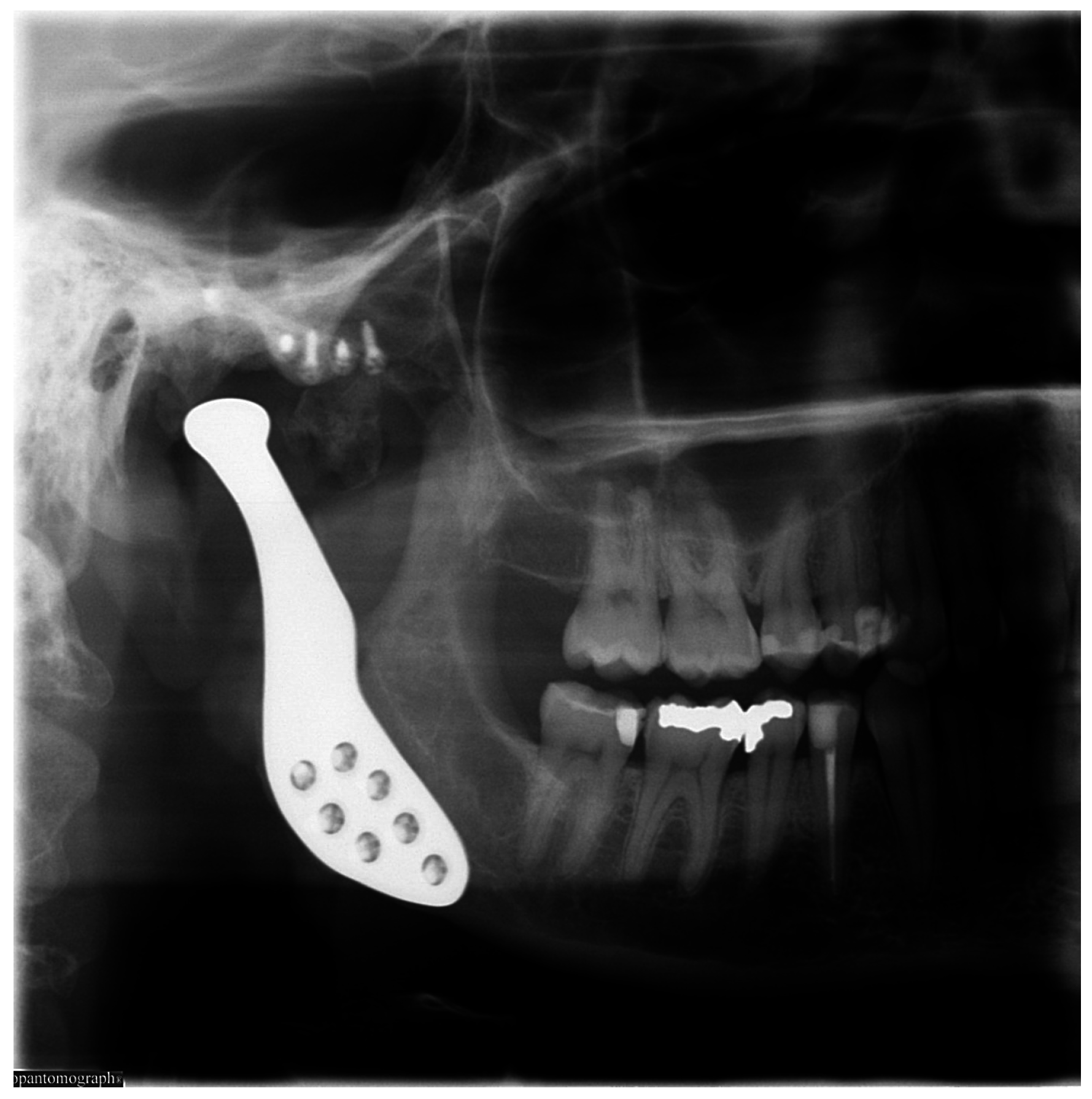 Dentistry Journal Free FullText Custom Made Replacement of the