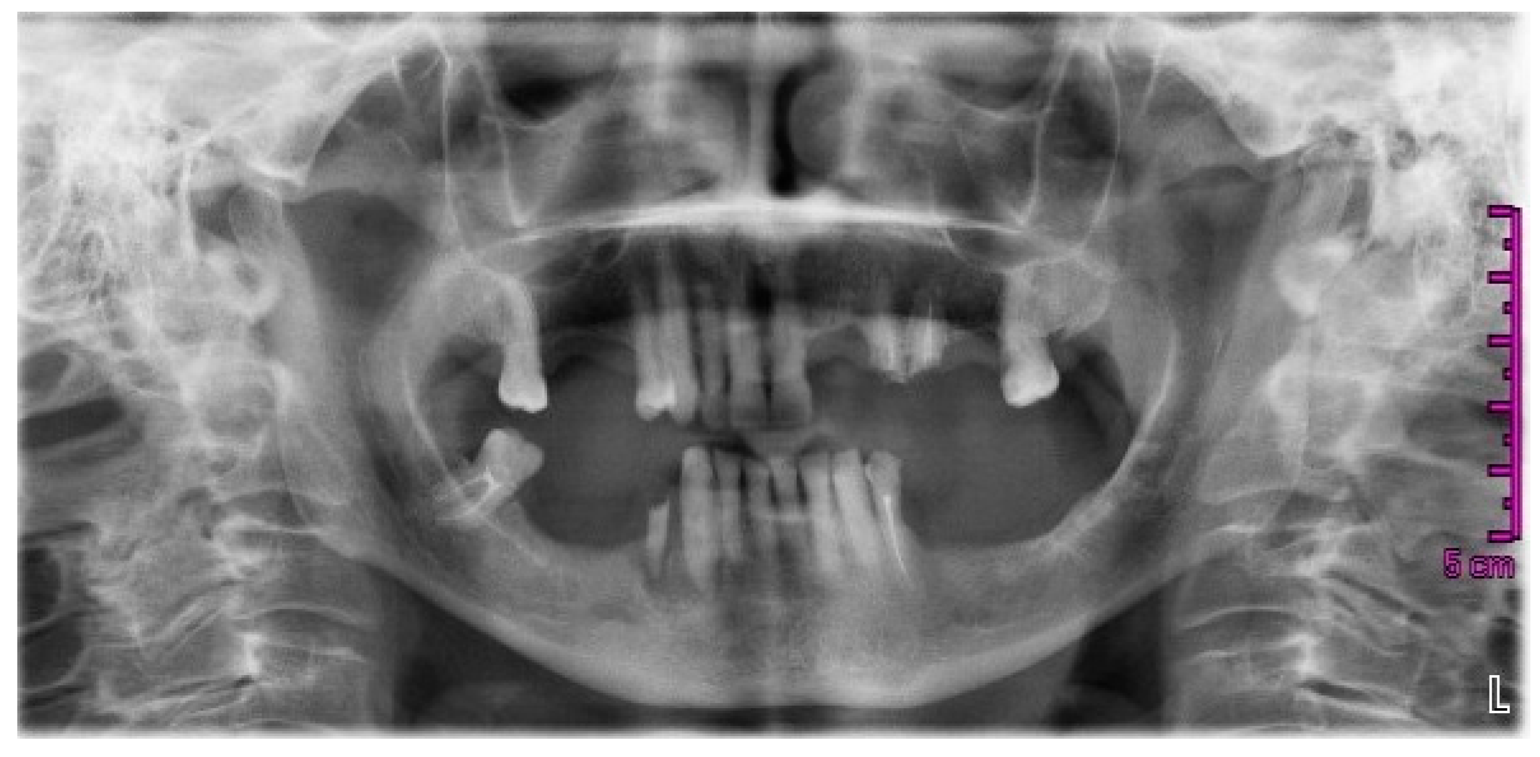 Dentistry Journal | Free Full-Text | Osteonecrosis of the Jaw (ONJ) in Osteoporosis ...