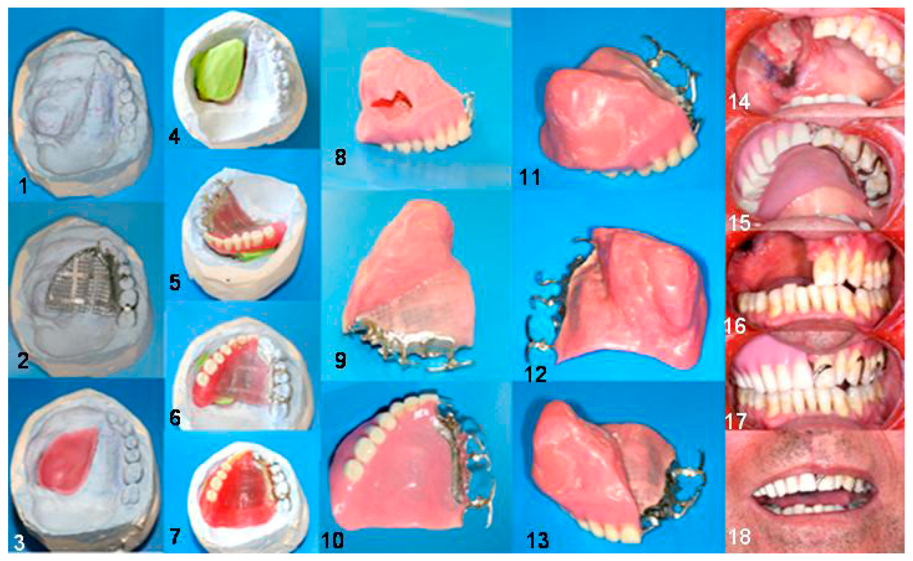 Dentistry Journal Free FullText The Effect of Immediate Obturator
