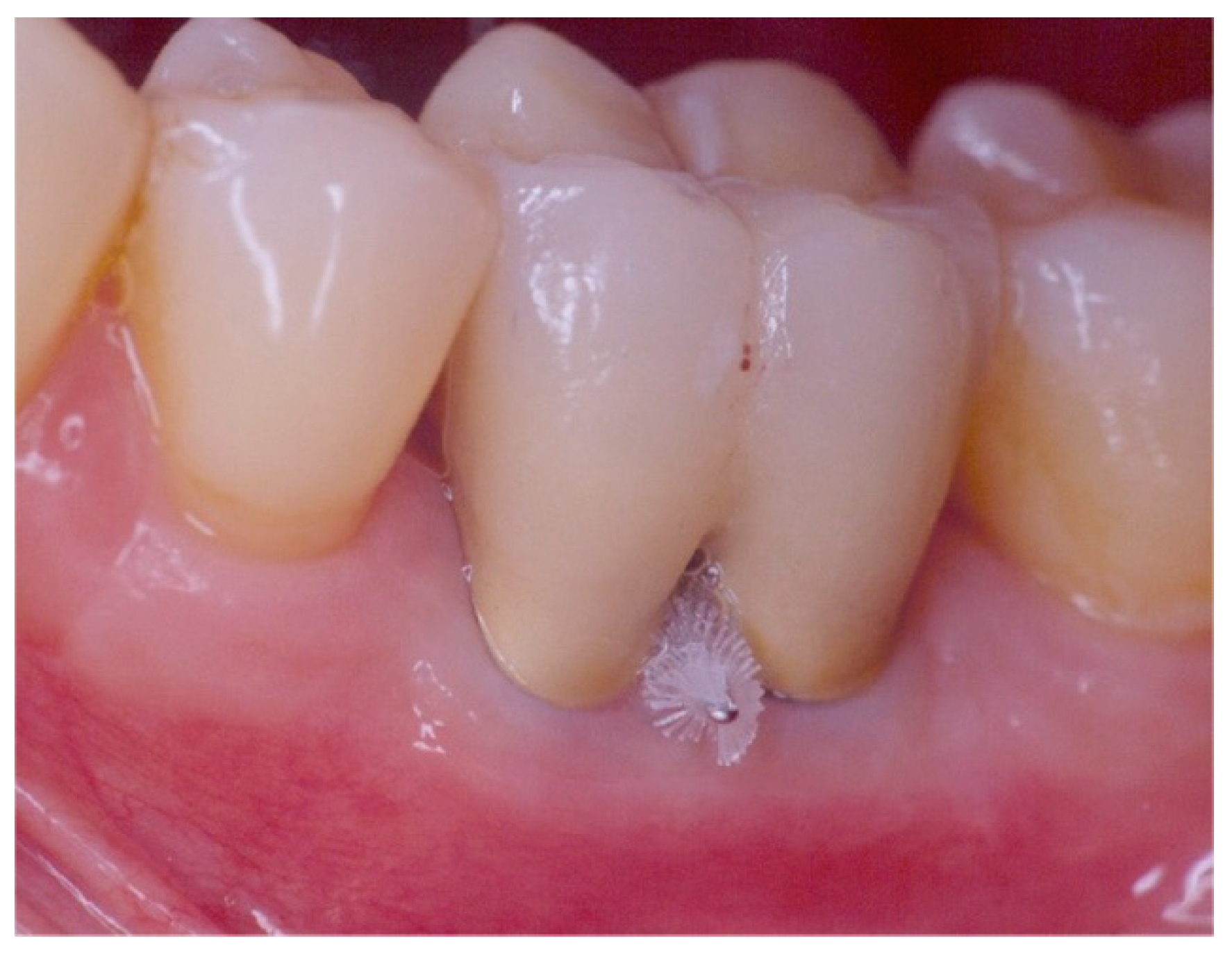 Dentistry Journal | Free Full-Text | Furcation Involvement