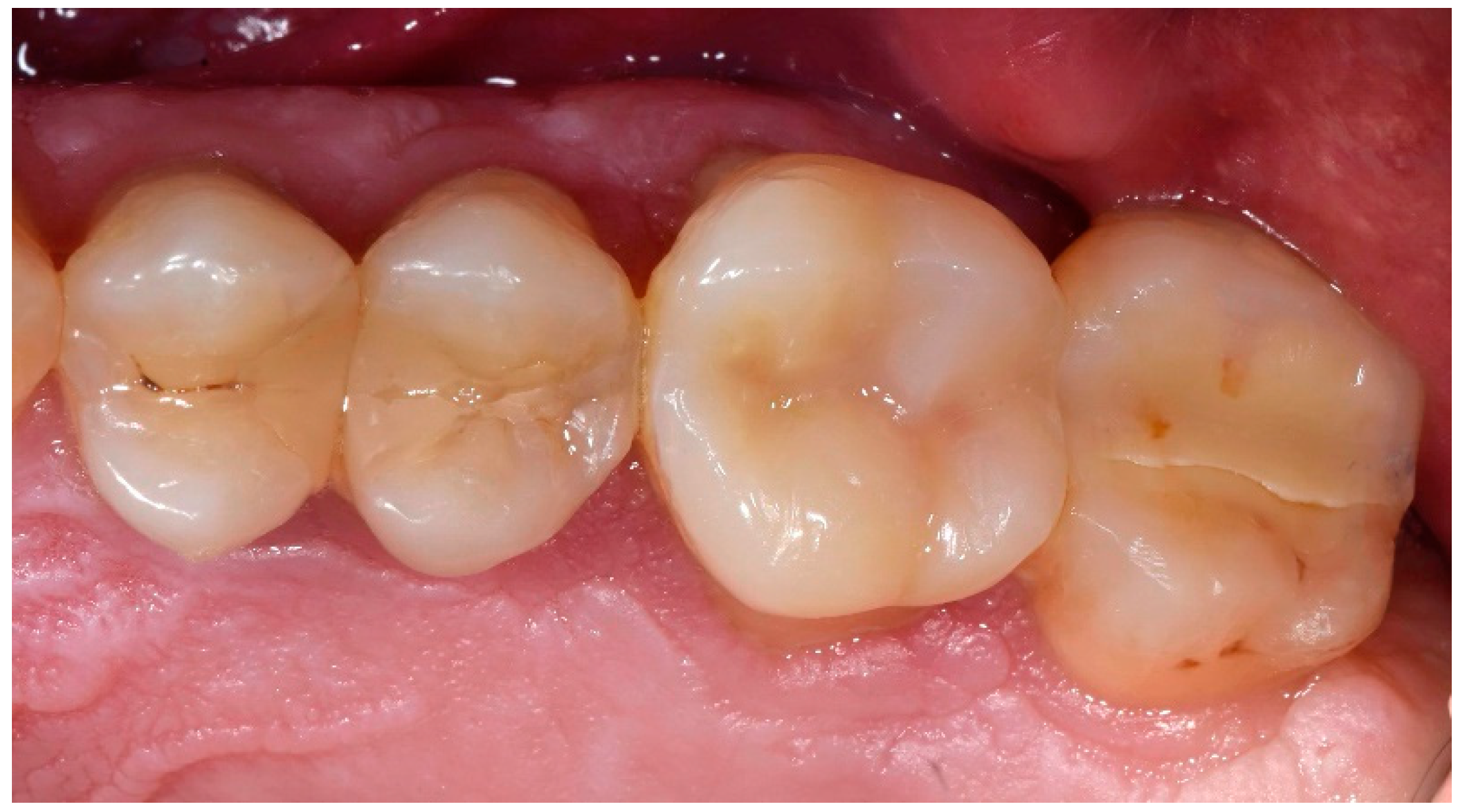 Restorations of teeth in stomatology on Serpuhovskaya Restorations of teeth in stomatology on Serpuhovskaya